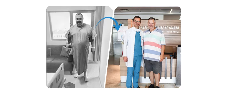 Transit Bipartition Surgery – 53 Kilograms Lost in 5 Months!