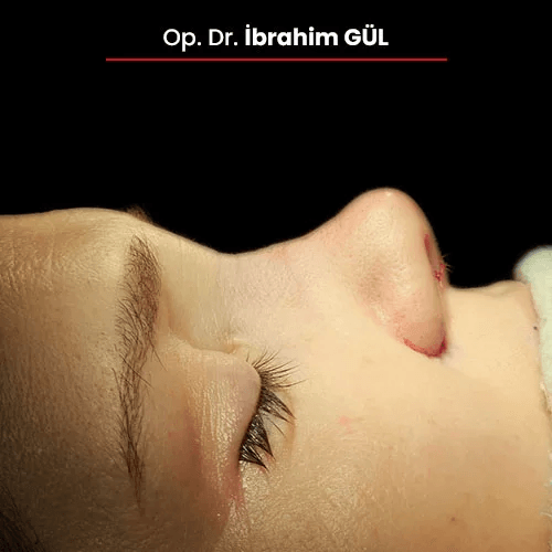 Öncesi Sonrası 1187456653