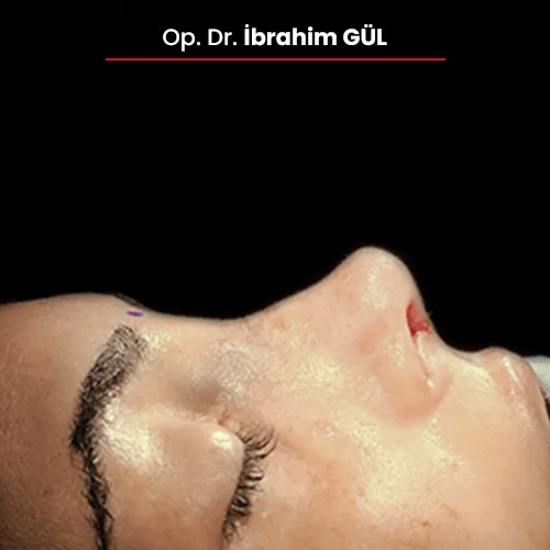 Öncesi Sonrası 98152837