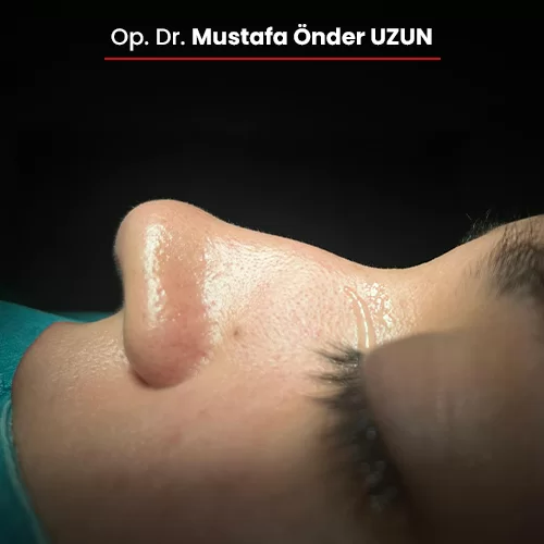 Öncesi Sonrası 1528615879