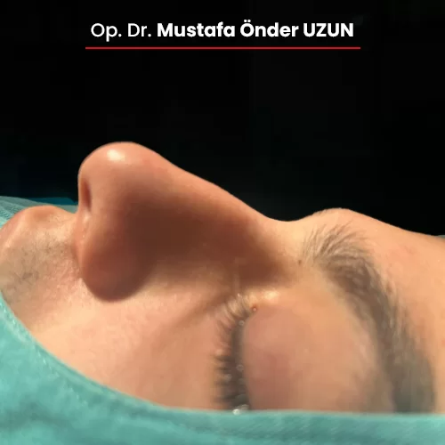 Öncesi Sonrası 76641736