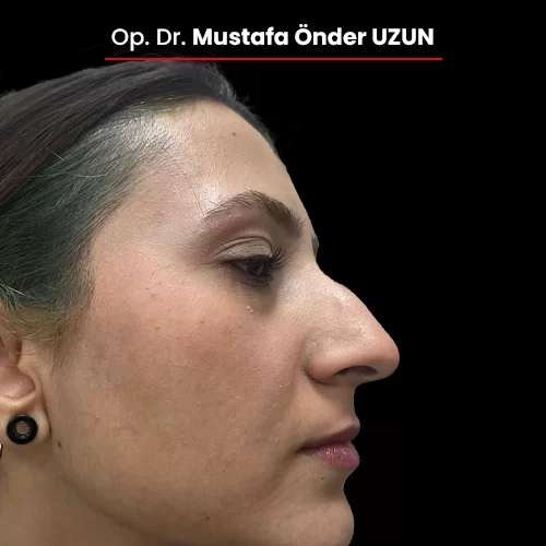 Öncesi Sonrası 1200112467