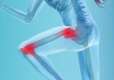 What Is Hip and Knee Joint Replacement?