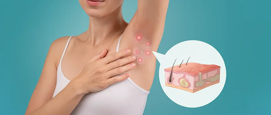 Hidradenitis Suppurativa – Diagnosis, Symptoms and Treatment