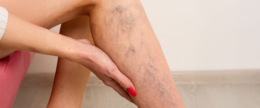 Non-surgical treatment of varicose veins in Turkey - modern, gentle and effective approach