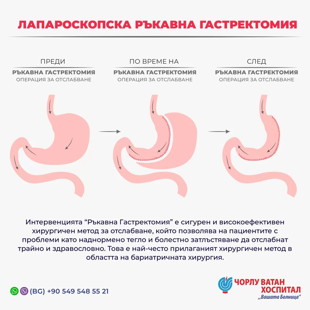 SLEEVE GASTRECTOMY