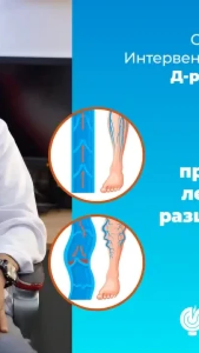 Varicose Veins – Causes, Symptoms and How to Deal with Them